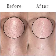 【男性専用★皮脂テカリ防止コース】毛穴洗浄 for men