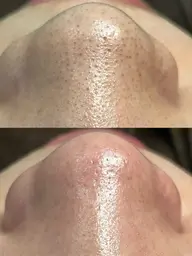 お鼻の黒ずみ撃退!お鼻の毛穴洗浄