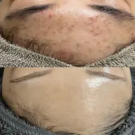 🔥【頑固な肌荒れ・毛穴に】REVIハーブピーリング《陶肌トリートメント》 ➕ CYリキッド0.8ml➕エンザイム1g