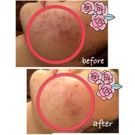 肌再生🌿ハーブピーリング(ハイドラ付き)