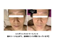 シミデトックストリートメント✨初回限定 6,000円✨