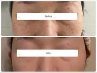 【シミ・たるみ改善】エイジングケアフェイシャル✨