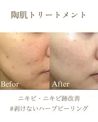 【初回お試し】ニキビ・ニキビ跡に特化‼️REVIハーブピーリング🌿+ニキビ用オプション付