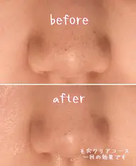毛穴クリアコース