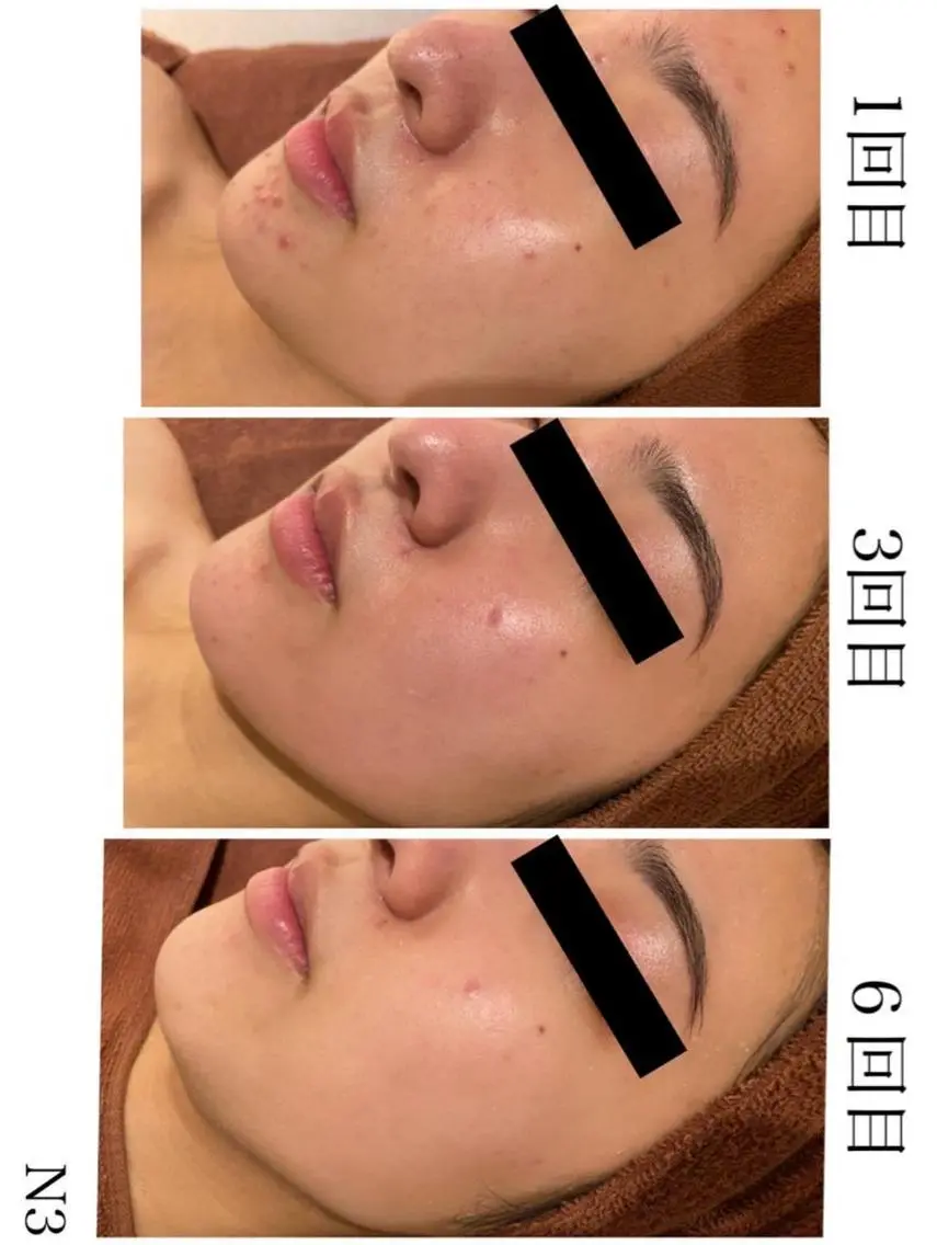 3か月で肌革命👼 ニキビ専門店💫のエステ・リラクイメージ