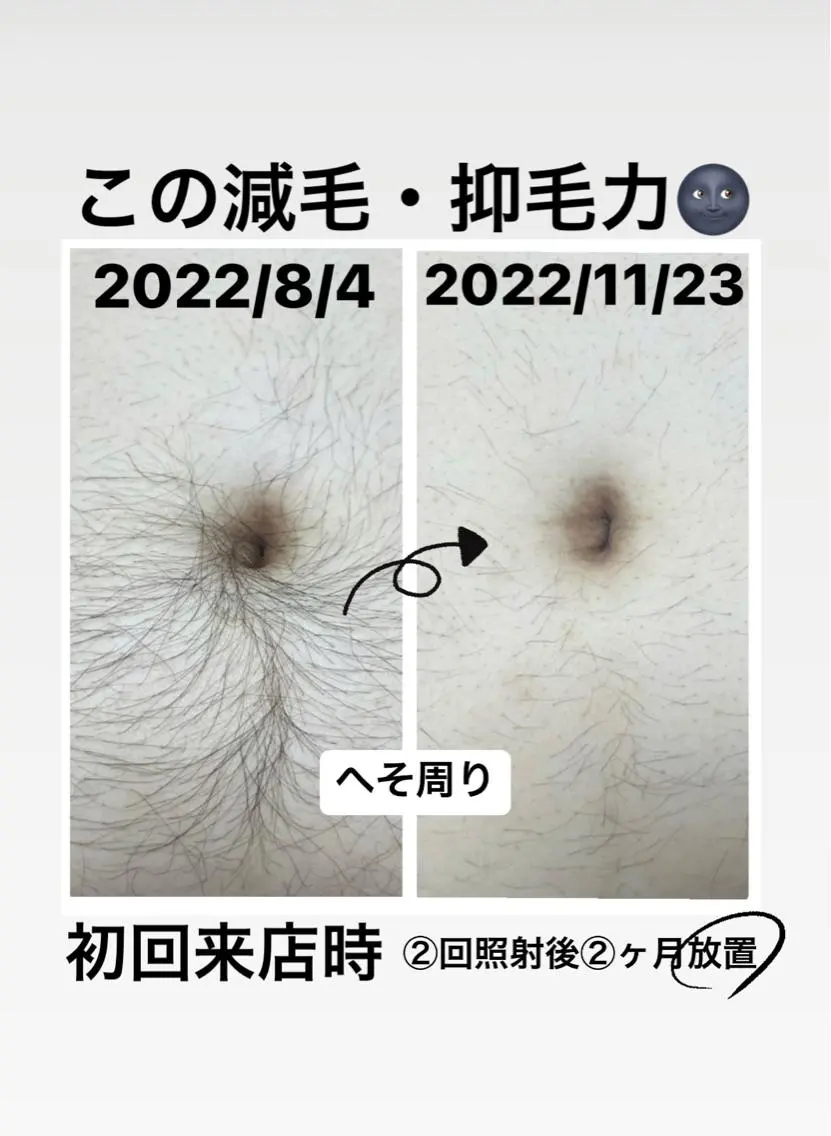 メンズ メンズハイライト 脱毛 メンズ脱毛サロン Le falcoのエステ・リラクイメージ