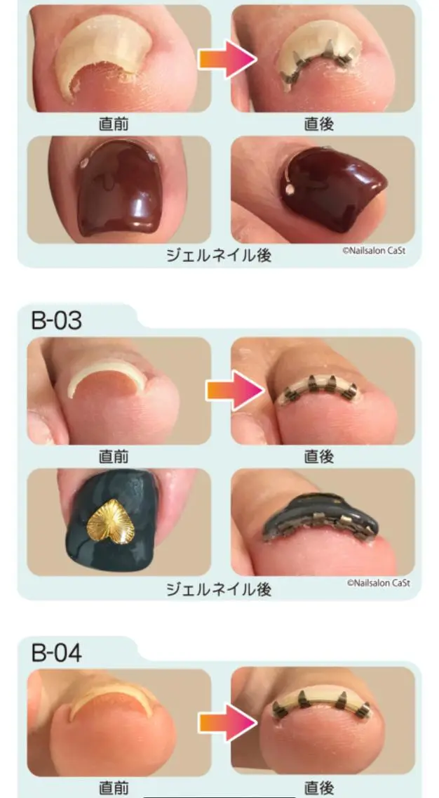 ネイル ジェルネイル ♢ME2ROOM♢ #巻き爪#リラクのネイルデザイン