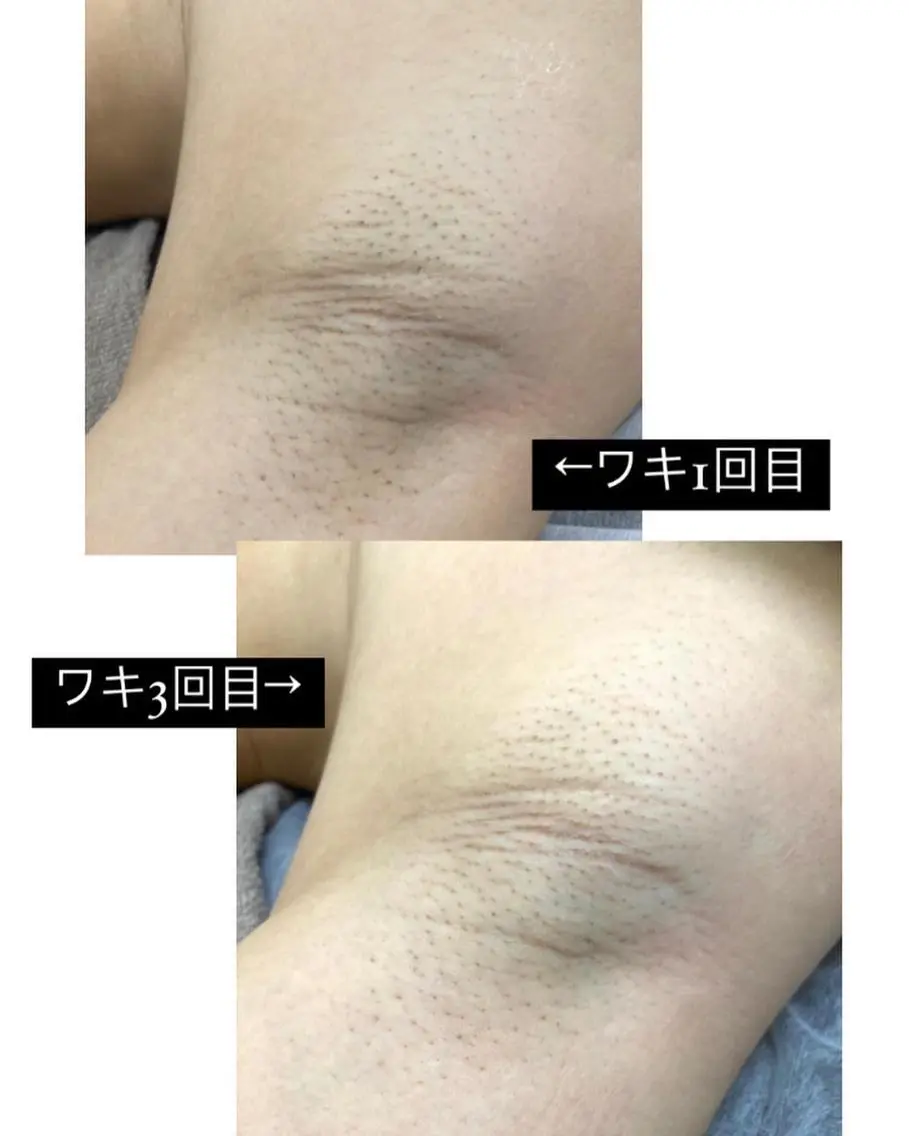 脱毛サロン Lilのエステ・リラクイメージ