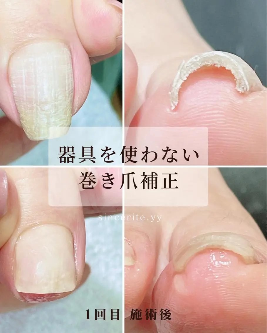 ネイル 深爪・巻き爪 専門サンセリテのネイルデザイン