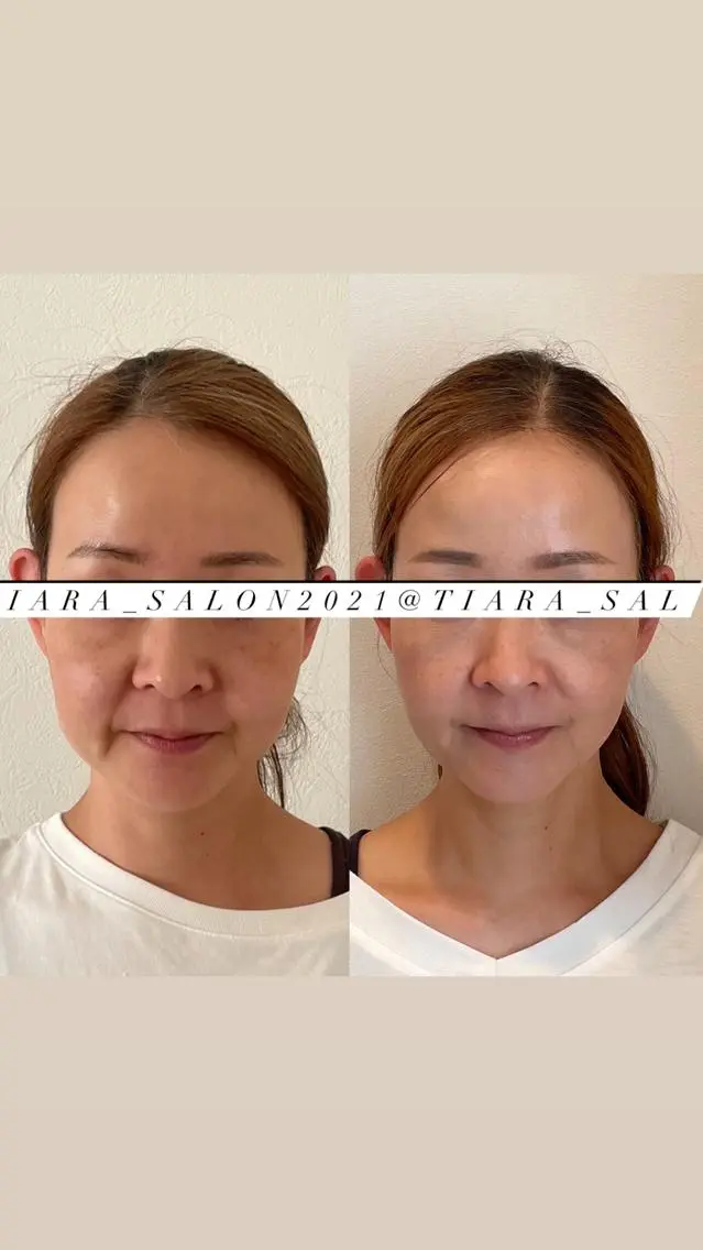 鍼灸サロン TIARA　美容鍼のエステ・リラクイメージ