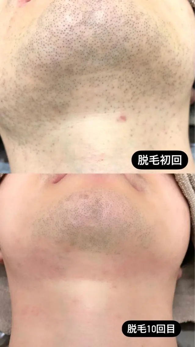 メンズ 脱毛 脱毛サロン Lilのエステ・リラクイメージ