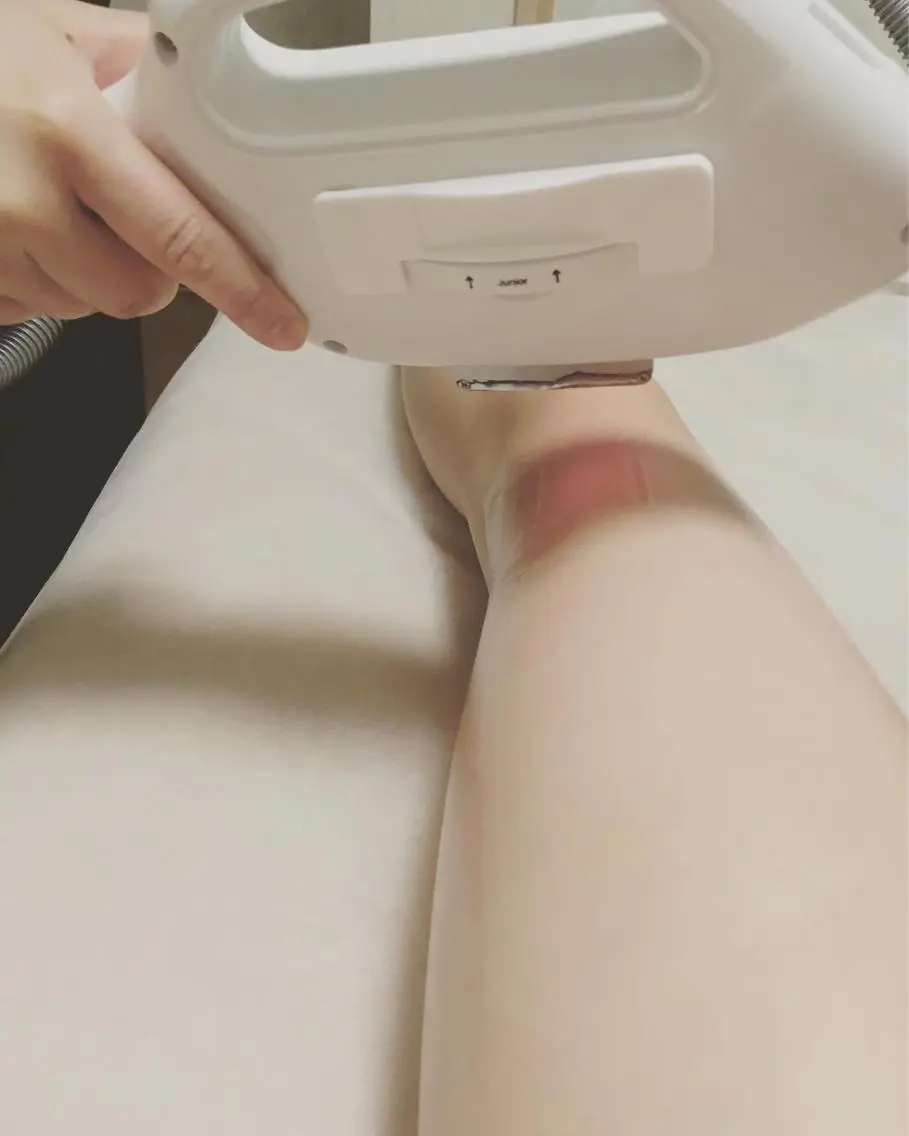 脱毛 A myのエステ・リラクイメージ