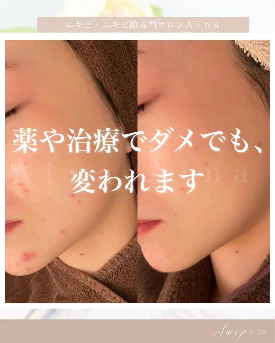 セミロング カラー パーマ ヘアアレンジ メンズ キッズ ネイル マツエク・マツパ アイブロウ 赤色 エステ リラク ニキビ跡専門サロン Ainaのエステ・リラクイメージ