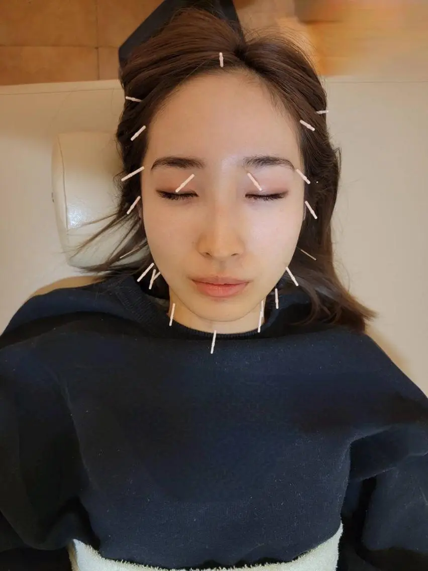 リフトアップ・たるみ ☆美容鍼小顔矯正のその他イメージ