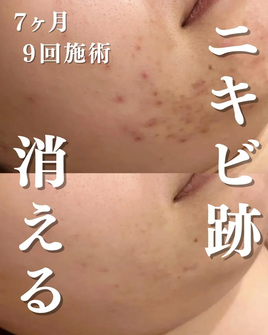 3か月で肌革命👼 ニキビ専門店💫のエステ・リラクイメージ