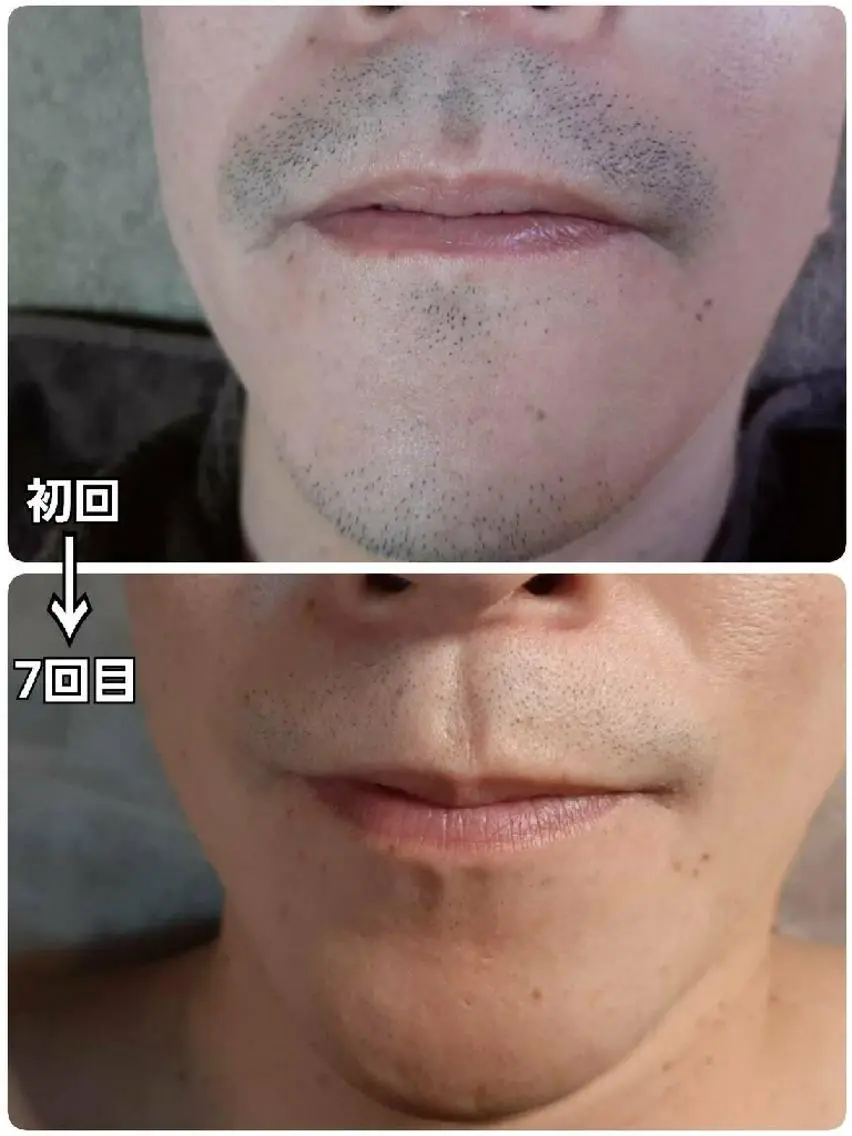 メンズ 山村幸久 メンズ脱毛 ディアーズのエステ・リラクイメージ