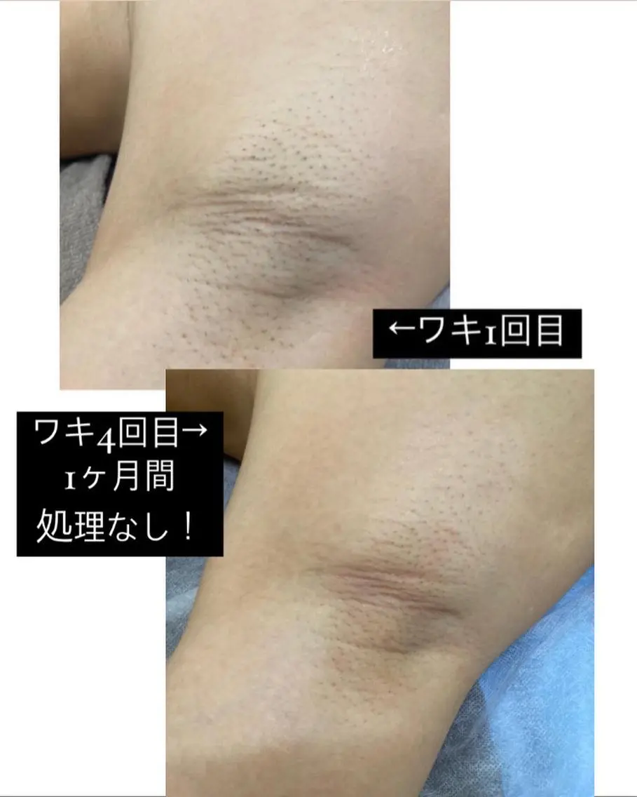 脱毛サロン Lilのエステ・リラクイメージ