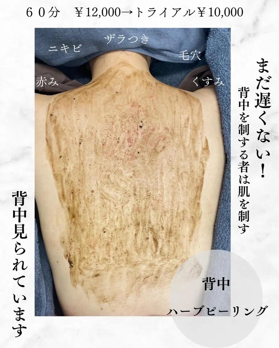 肌質改善美容鍼 ×ハーブピーリングのエステ・リラクイメージ