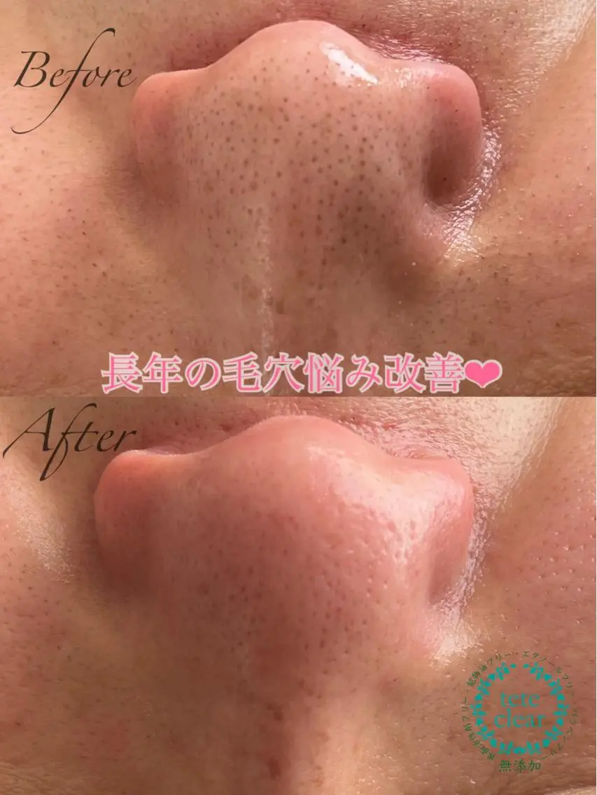 毛穴/シミ肝斑/脱毛 横山梨里のエステ・リラクイメージ
