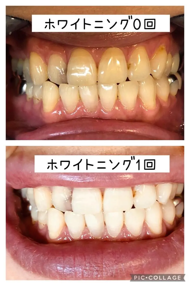 ホワイトニング🦷 ネイル💅LEAのその他イメージ