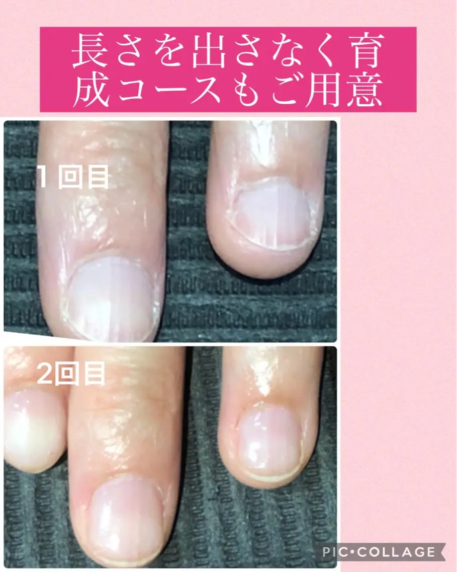 ネイル 深爪矯正長さ出し専門 グレースレディのネイルデザイン
