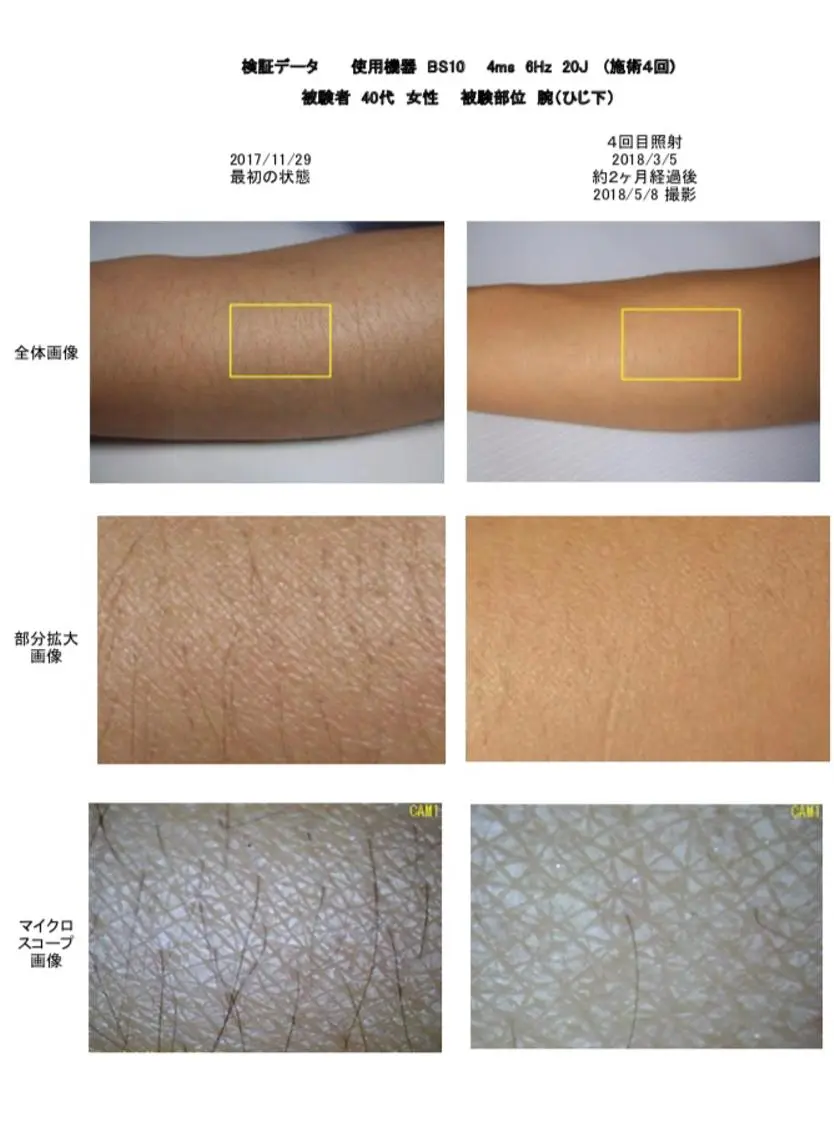脱毛 セルフ脱毛 One Salonのエステ・リラクイメージ