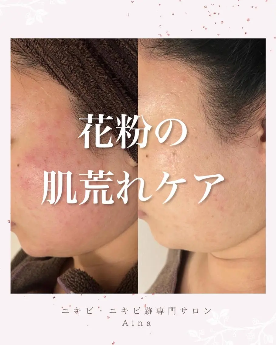 ロング パーマ ヘアアレンジ メンズ キッズ ネイル マツエク・マツパ アイブロウ 赤色 春ネイル ニキビ跡専門サロン Ainaのエステ・リラクイメージ