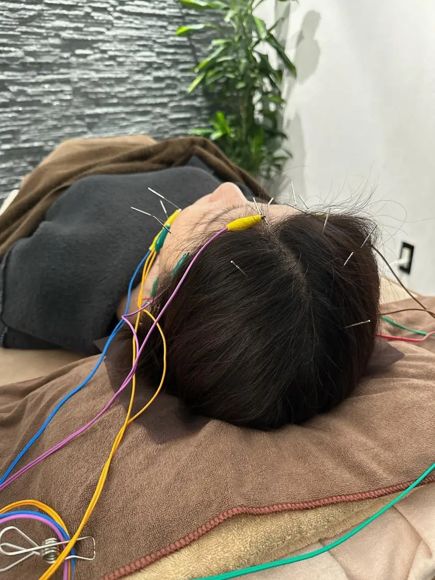 その他 小顔矯/美容鍼/鍼灸 BeauJuのその他イメージ