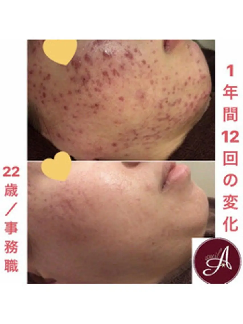 ショート カラー パーマ ヘアアレンジ メンズ キッズ ネイル マツエク・マツパ エステ リラク ニキビ・肌質改善専門 ♡人生が変わるサロンのエステ・リラクイメージ