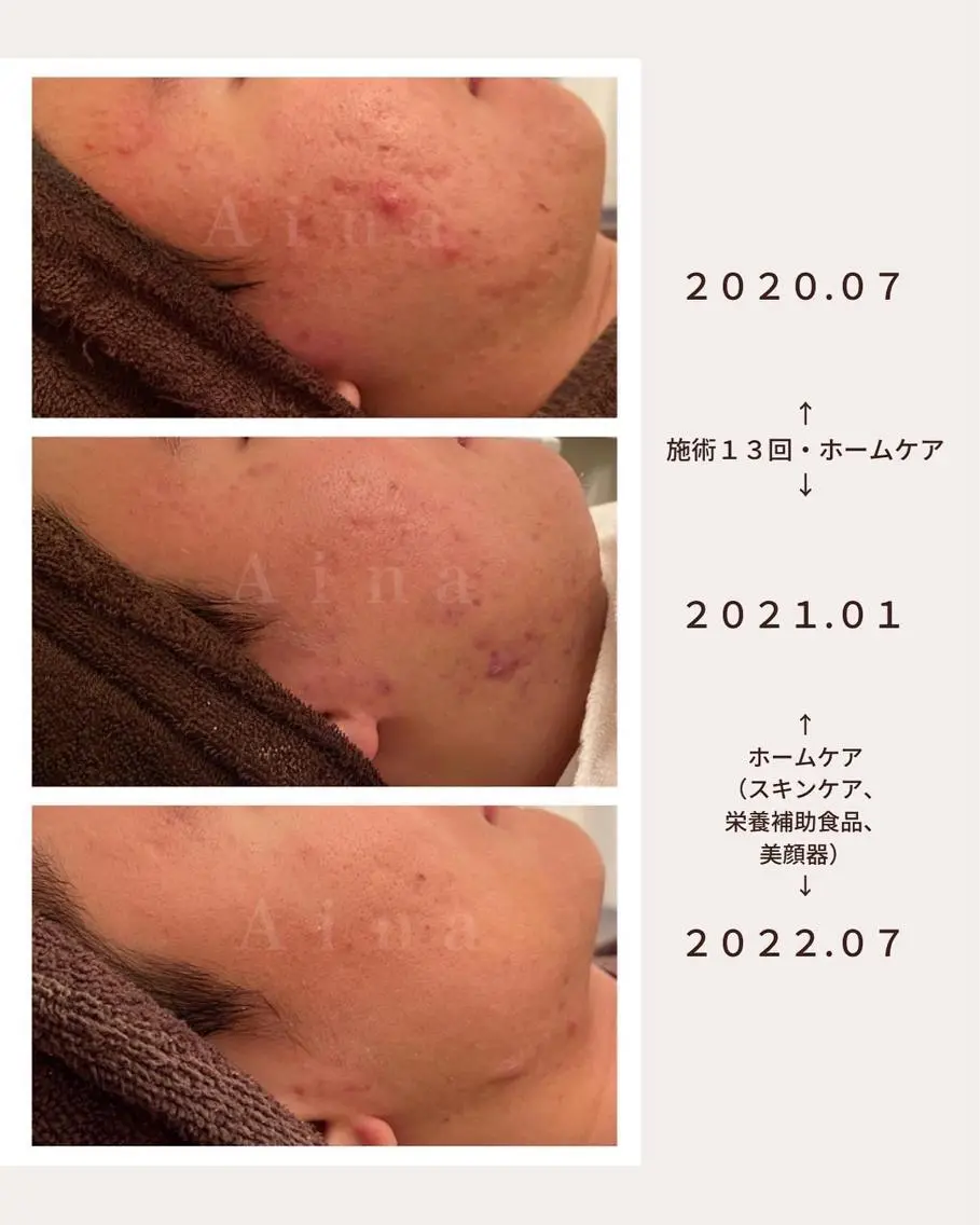 セミロング パーマ ヘアアレンジ メンズ キッズ ネイル マツエク・マツパ エステ リラク ニキビ跡専門サロン Ainaのエステ・リラクイメージ