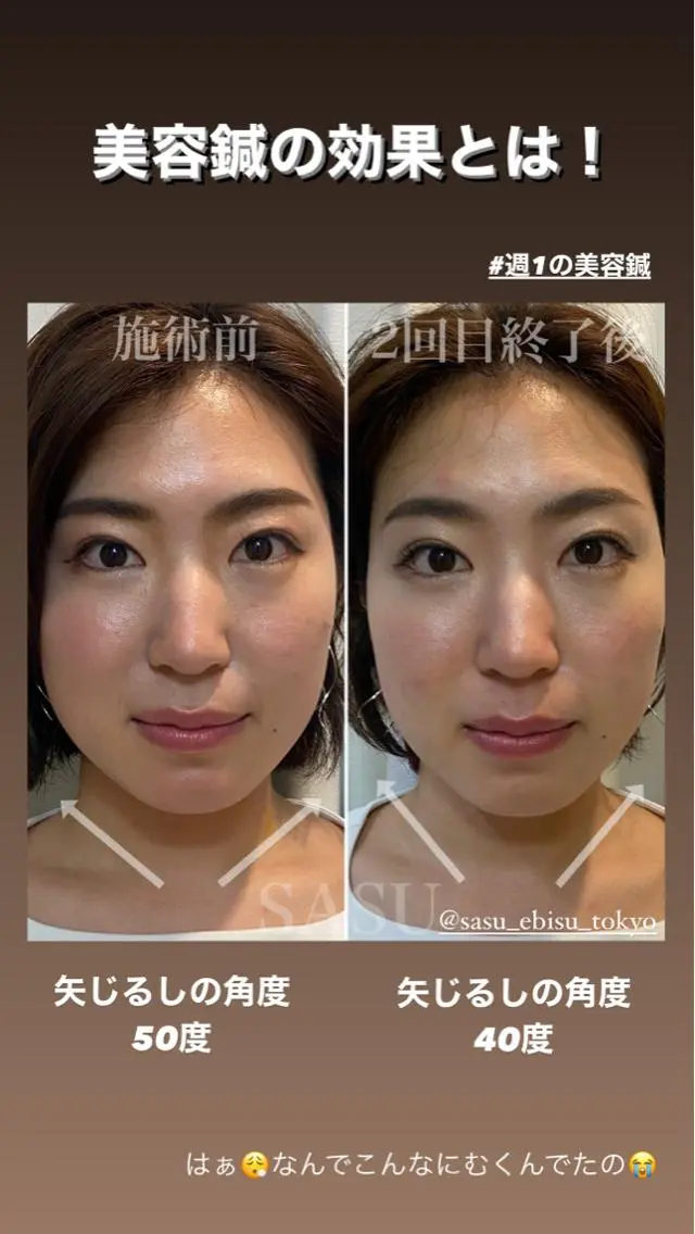 カラー パーマ ヘアアレンジ メンズ キッズ マツエク・マツパ アイブロウ その他 即小顔♥️美容鍼× ハーブピーリングのその他イメージ
