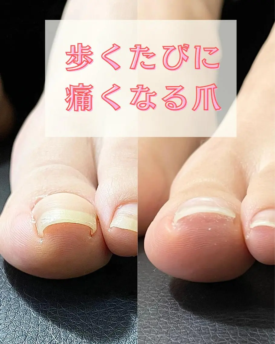 ネイル 深爪・巻き爪 専門サンセリテのネイルデザイン