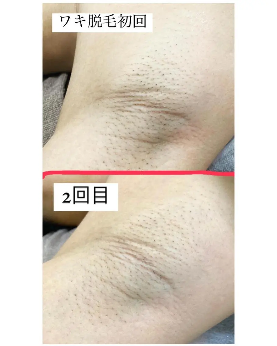 脱毛サロン Lilのエステ・リラクイメージ