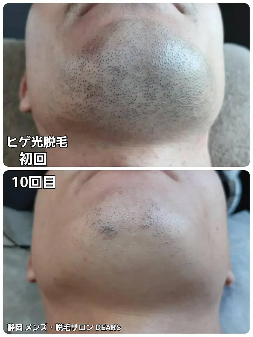 メンズ 山村幸久　メンズ脱毛 ディアーズのエステ・リラクイメージ
