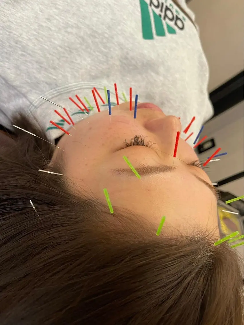 その他 小顔矯/美容鍼/鍼灸 BeauJuのその他イメージ