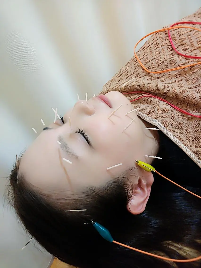 リフトアップ・たるみ ☆美容鍼小顔矯正のその他イメージ