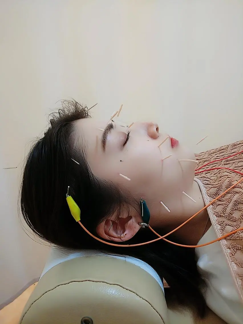 リフトアップ・たるみ ☆美容鍼小顔矯正のその他イメージ