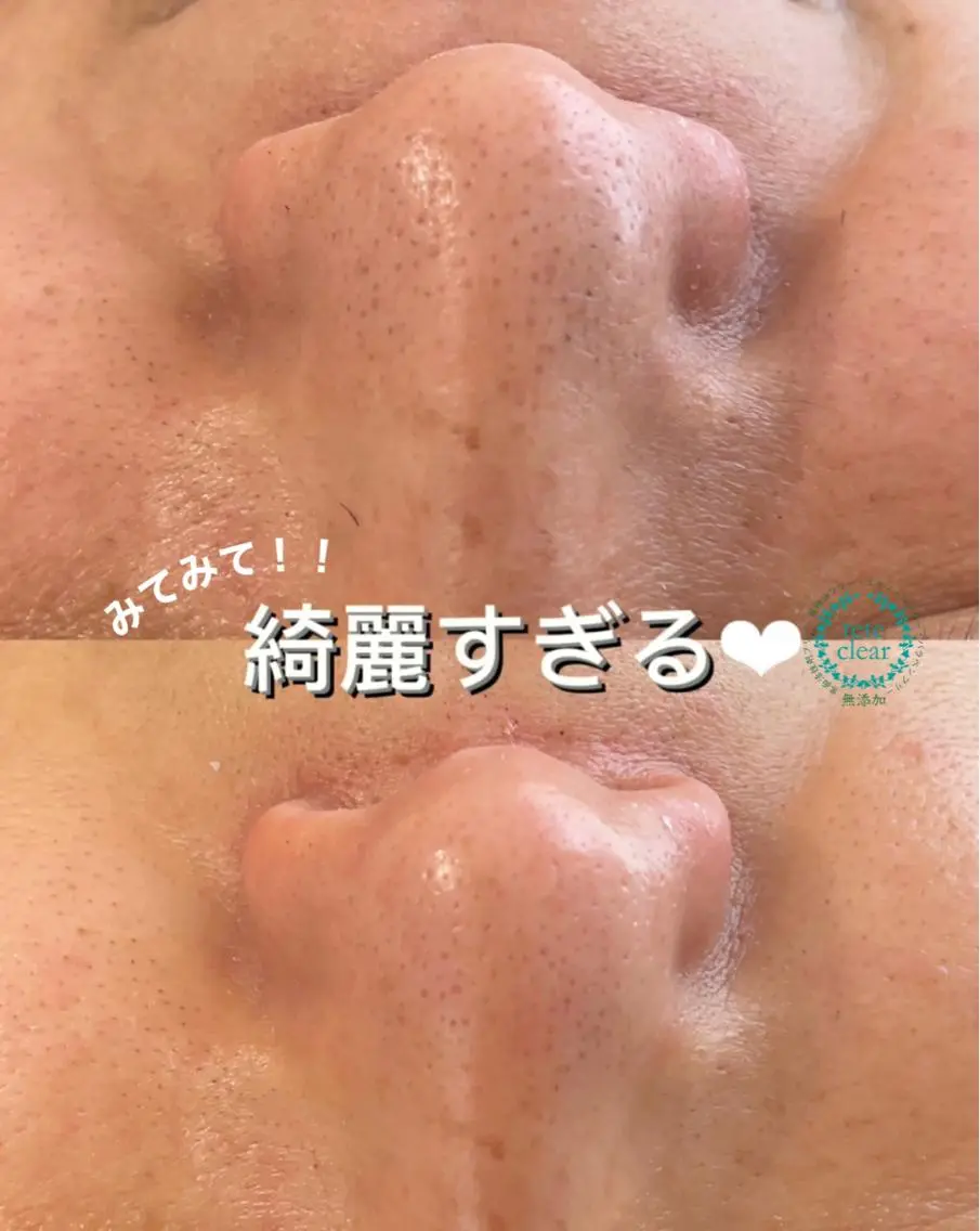 毛穴/シミ肝斑/脱毛 横山梨里のエステ・リラクイメージ