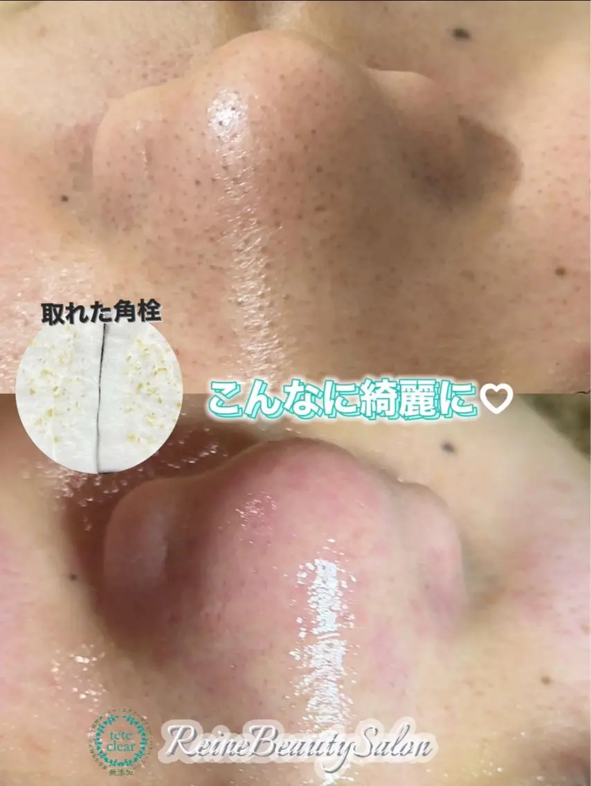 毛穴/シミ肝斑/脱毛 横山梨里のエステ・リラクイメージ