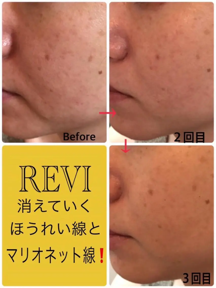 ハーブピーリング専門 毛穴洗浄❤️眉waxのエステ・リラクイメージ