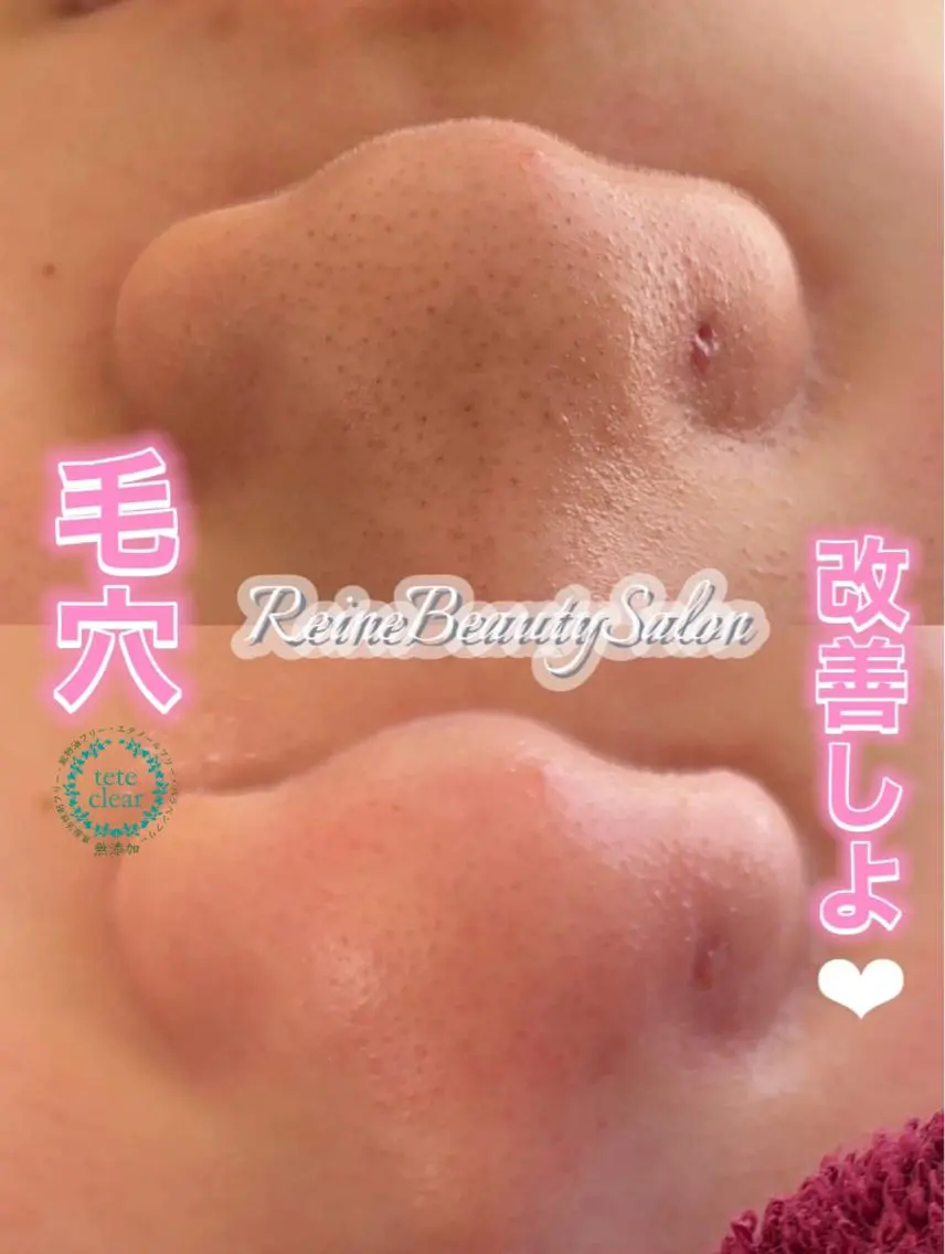 毛穴/シミ肝斑/脱毛 横山梨里のエステ・リラクイメージ