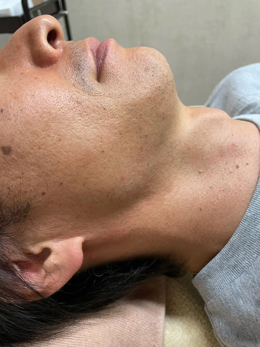 メンズ 脱毛 メンズビューティー 池村哲雄のエステ・リラクイメージ