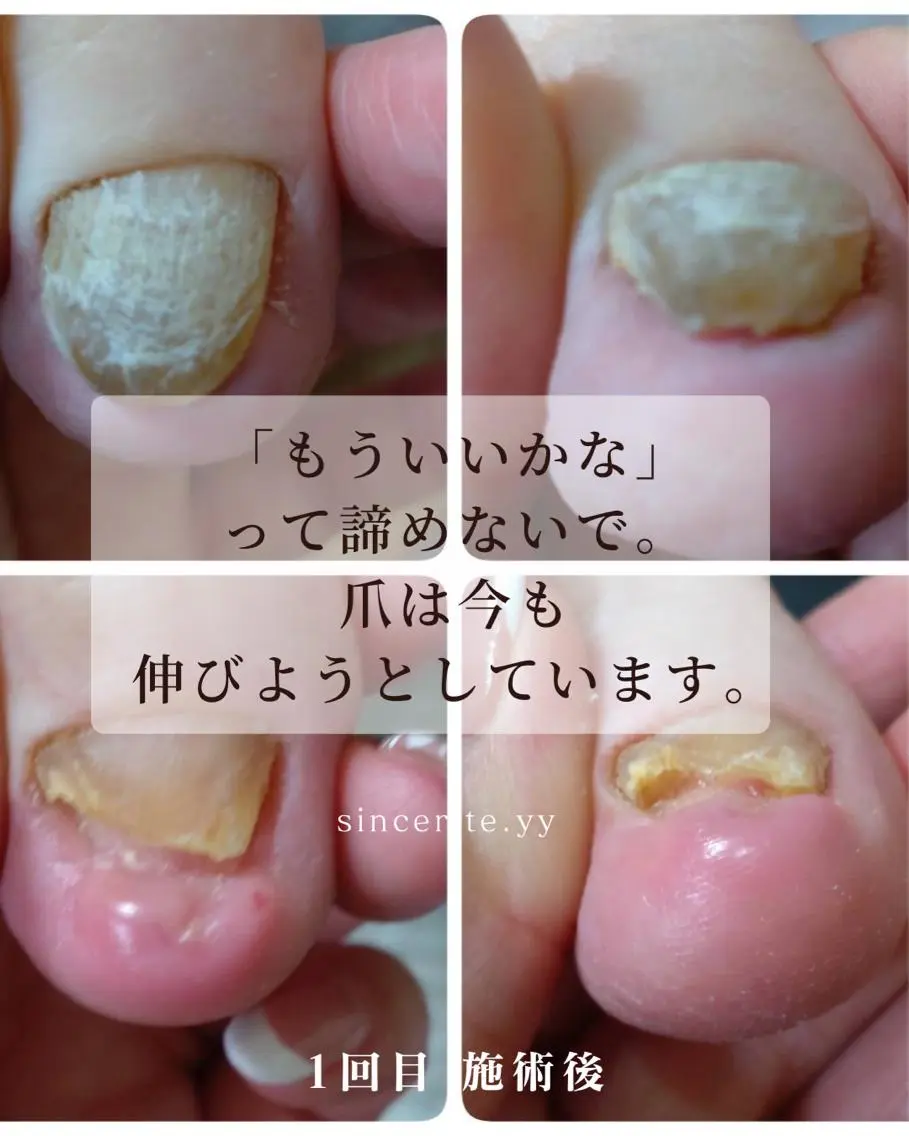 ネイル 巻き爪・肥厚爪ケア 専門サンセリテのネイルデザイン