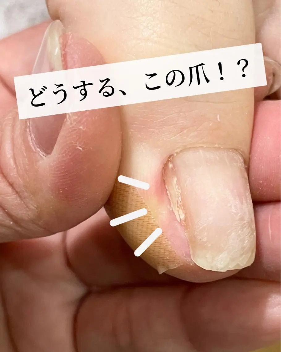 ネイル 深爪・巻き爪 専門サンセリテのネイルデザイン