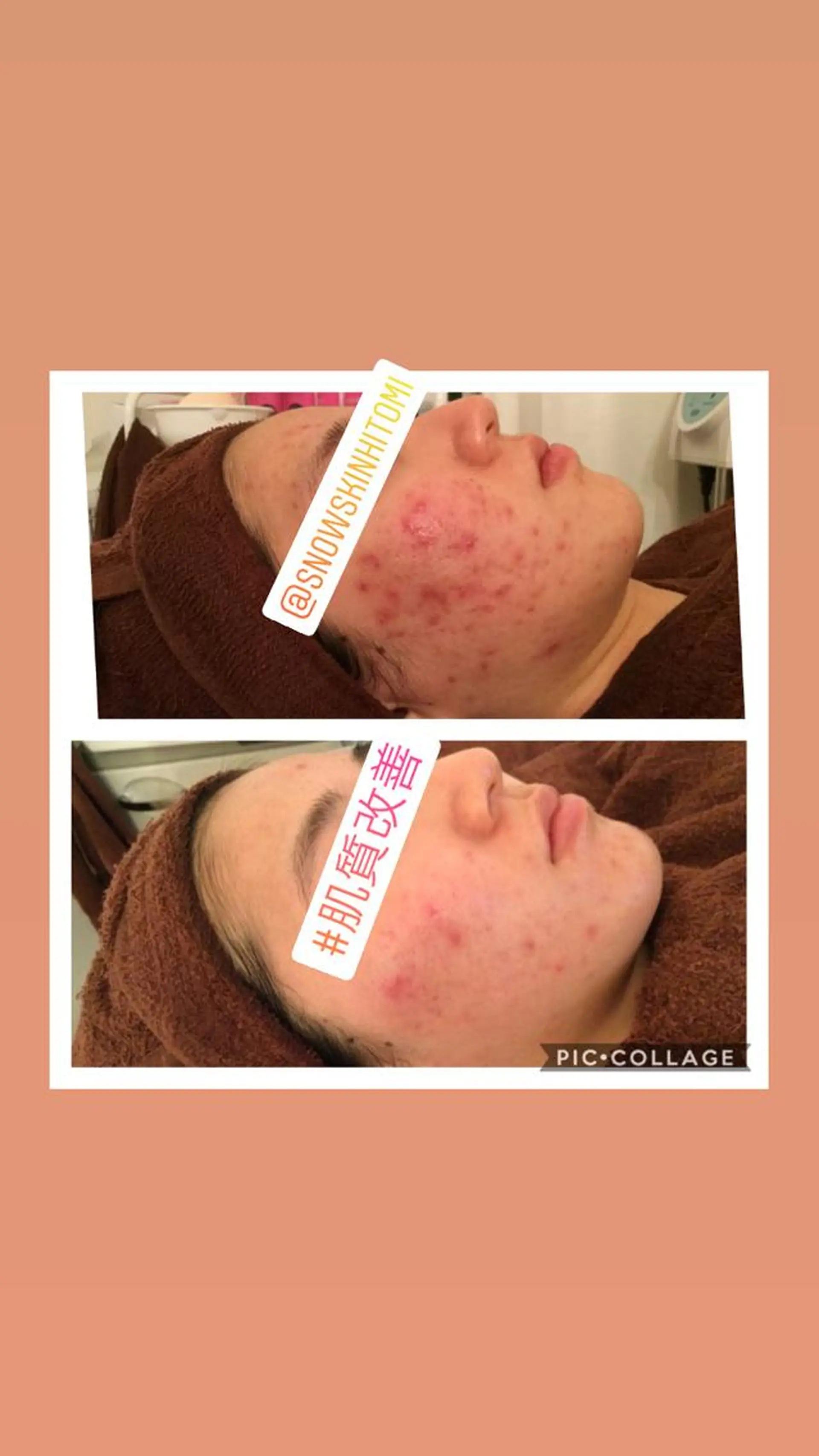 エステ リラク ニキビ/肌質改善専門 Snow skinのエステ・リラクイメージ