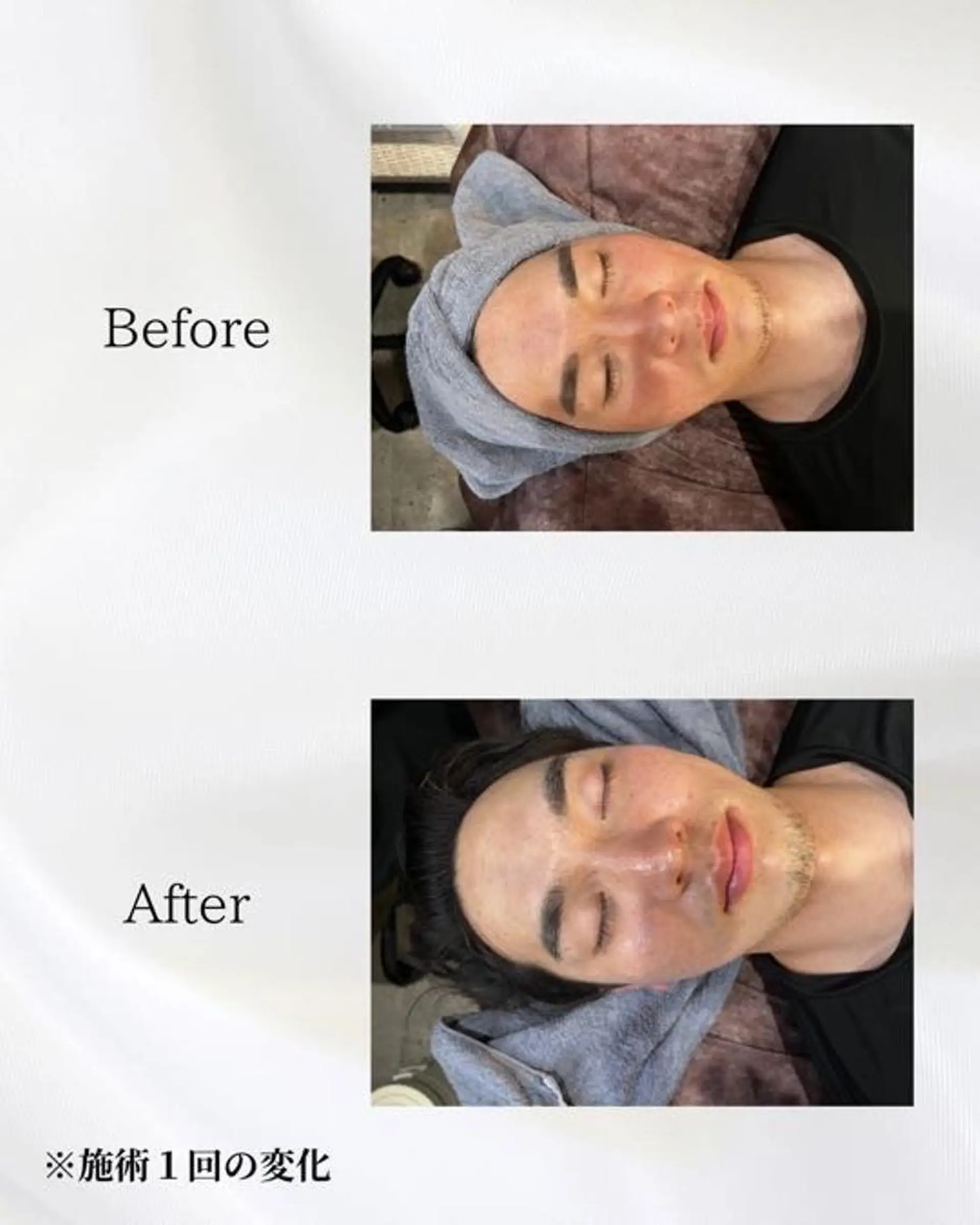 エステ ハーブピーリング🌿 REVI/Ayanoのエステ・リラクイメージ