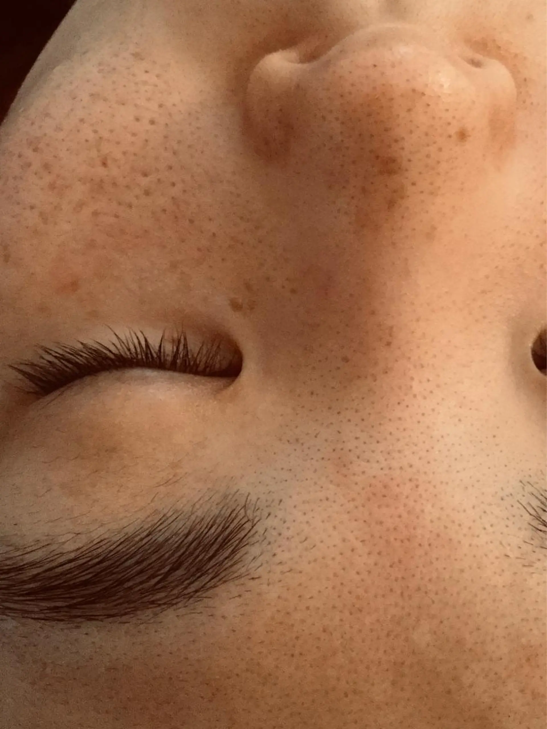 エステ リラク ニキビ/肌質改善専門 Snow skinのエステ・リラクイメージ