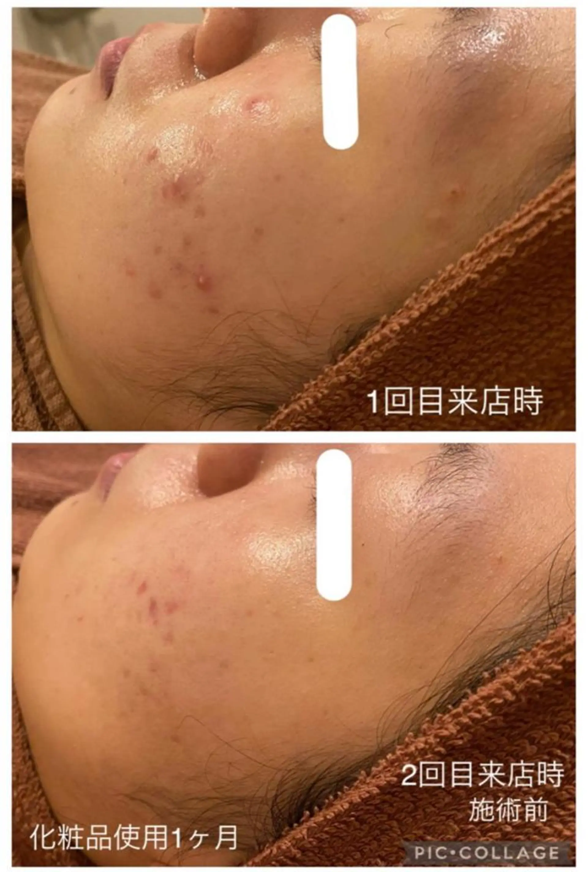 3か月で肌革命👼 ニキビ専門店💫のエステ・リラクイメージ