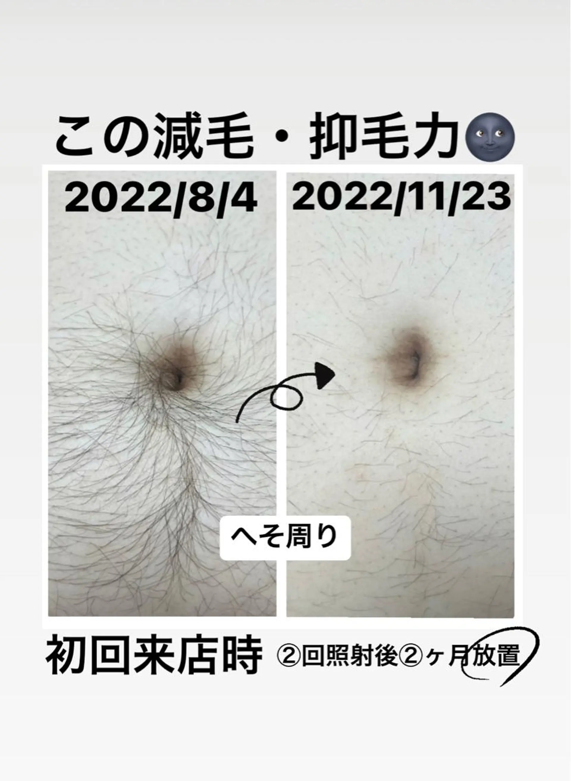 メンズ メンズハイライト 脱毛 メンズ脱毛サロン Le falcoのエステ・リラクイメージ