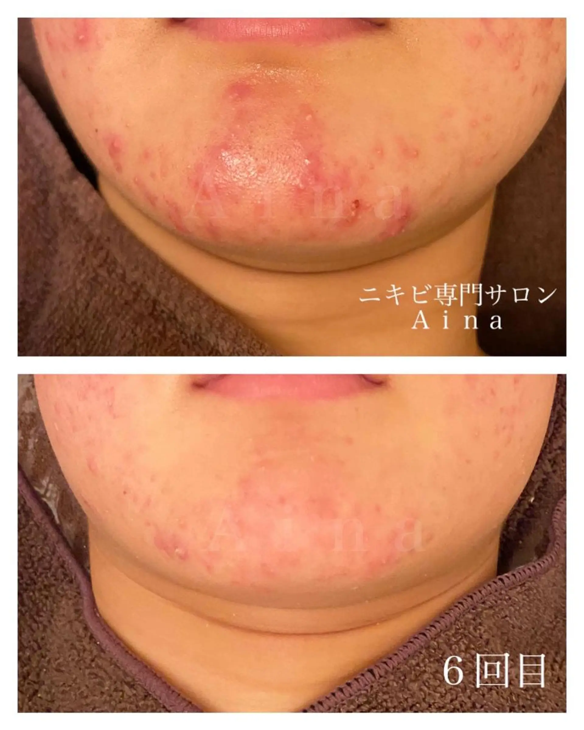 ミディアム カラー パーマ ヘアアレンジ メンズ キッズ ネイル マツエク・マツパ 赤色 エステ リラク ニキビ跡専門サロン Ainaのエステ・リラクイメージ